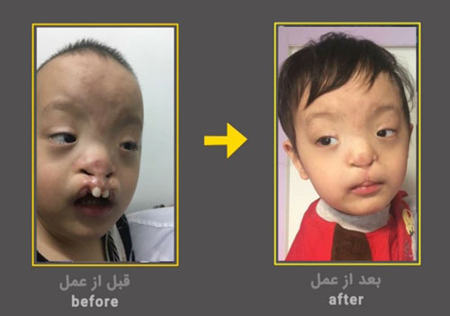 تصویر یک بیمار مبتلا به شکاف کام و لب در قبل و بعد از عمل در خیریه زنجیره امید