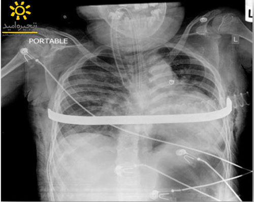 تصویر رادیولوژی بعد از جراحی سینه قیفی با تجهیزاتی به نام ناس