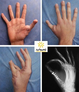 تصویرهای عمل جراحی پیوند انگشت پا به دست که در خیریه زنجیره امید انجام شده